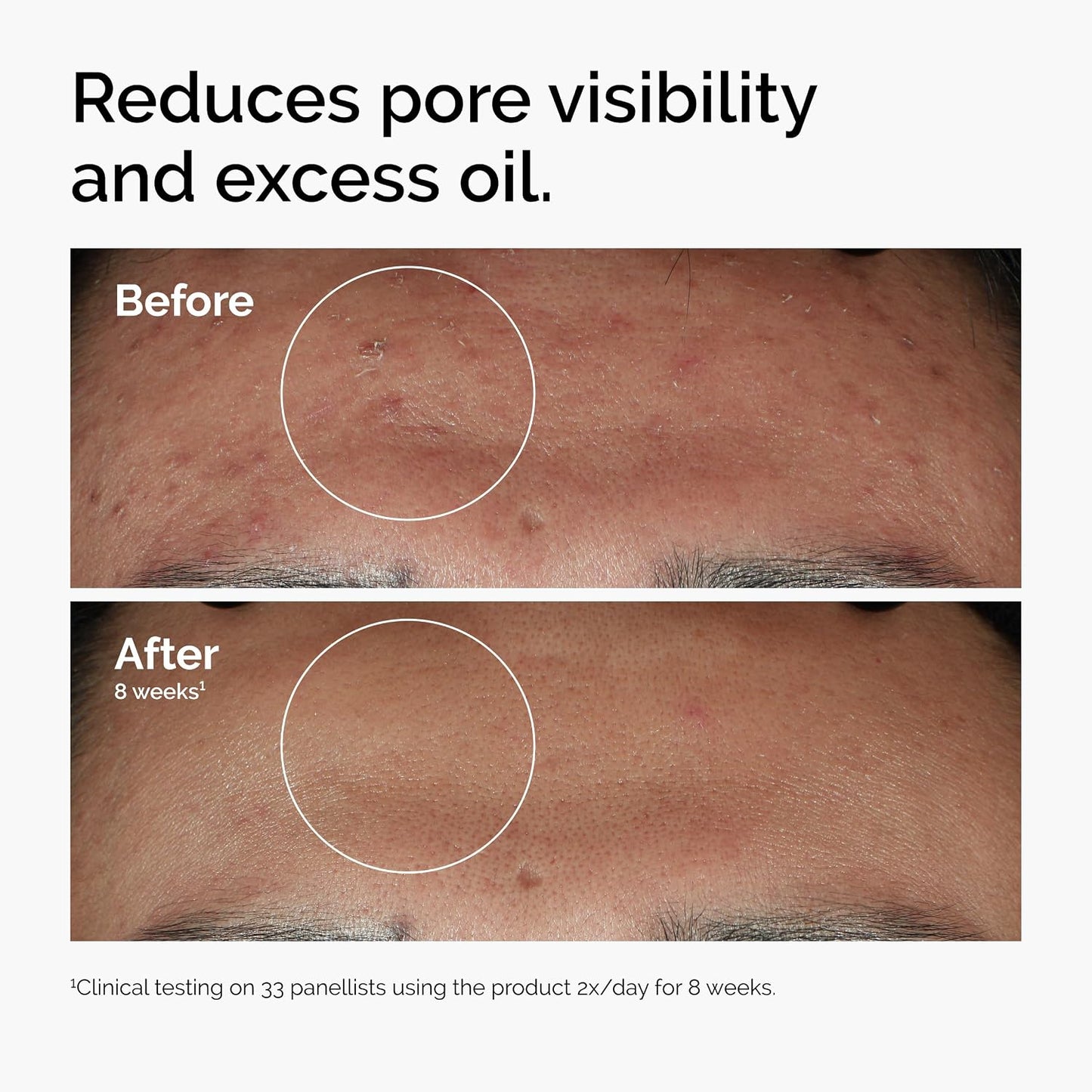 The Ordinary Niacinamide 10% + Zinc 1% | High-Strength Blemish & Pore Refining Serum