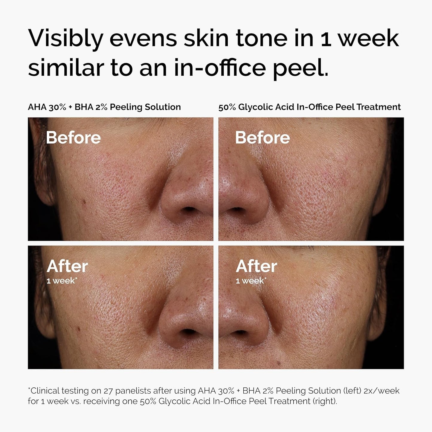 The Ordinary AHA 30% + BHA 2% Peeling Solution | 10-Minute Exfoliating Facial for Brighter, Smoother